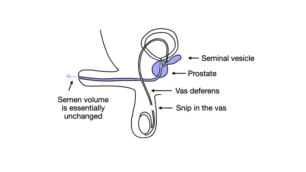 diagrams of semen flow from prostate and seminal vesicles after vasectomy - John Curington MD